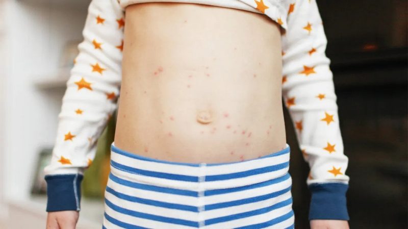 Foods To Recover From Chickenpox